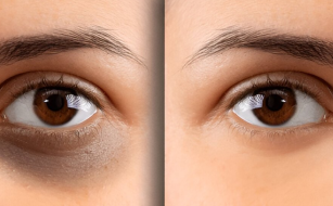 oculoplastic-aesthetic